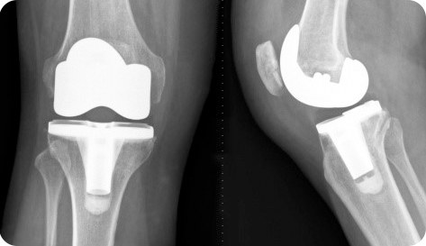 Prótesis de rodilla